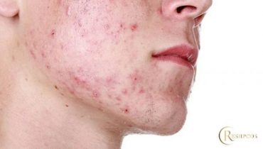 Cách nhận biết và chữa da mặt bị nghiện Corticoid, tác hại Corticoid